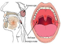 Vector illustration of a disease of the adenoids with the affected agencies.