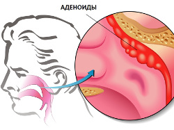 адноиды у вз