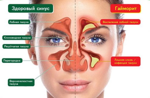 Здоровые пазухи и гайморит