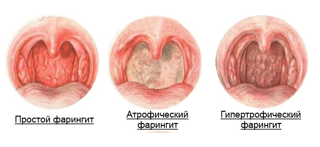 хронический фарингит