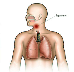 ларингит