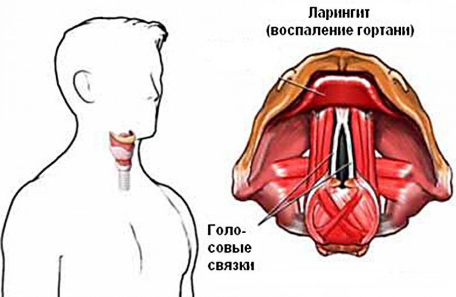 ларингит