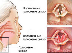 ларингит у детей