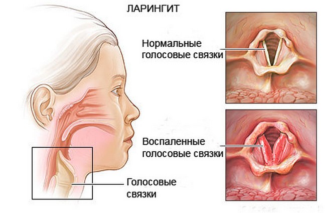 ларингит