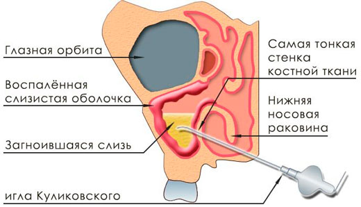 схема прокола пазух носа