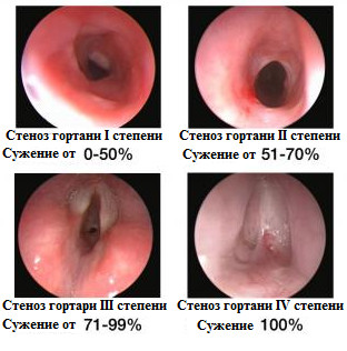 стеноз гортани