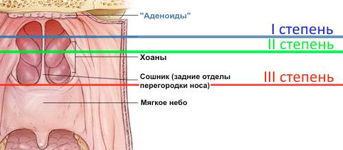 степени-гипертрофии-аденоидов