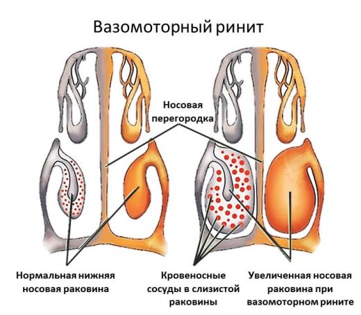 схема ринита