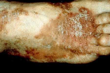 Заболевание на ноге Заболевание на ноге