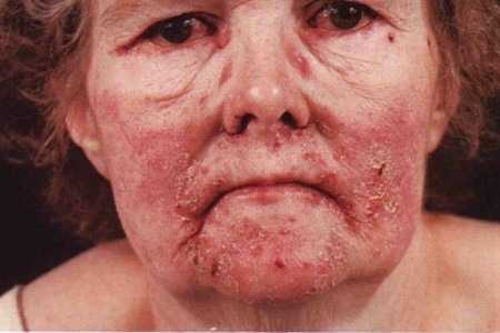 Заболевание на лице Заболевание на лице