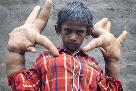 Заболевание у мальчика Заболевание у мальчика