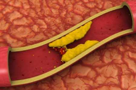 Тромб в вене Тромб в вене