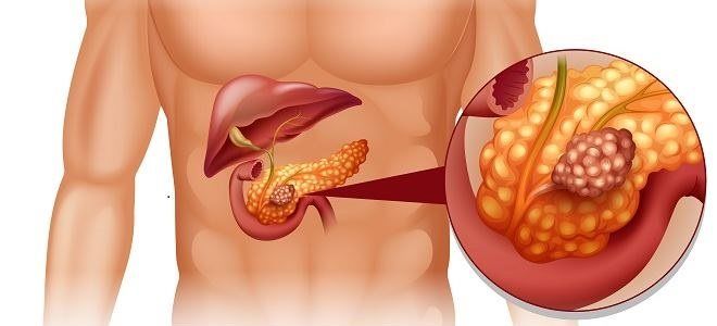 Особенности диффузных изменений поджелудочной железы
