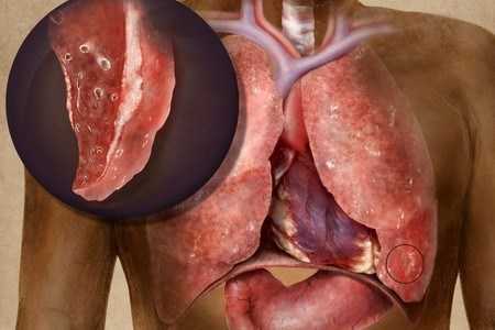 Туберкулез легких