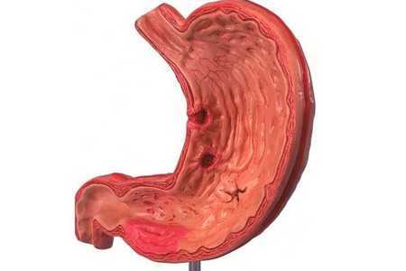 Желудок с язвами Желудок с язвами