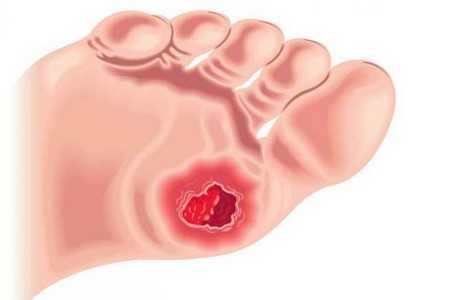 Язва на ноге Язва на ноге