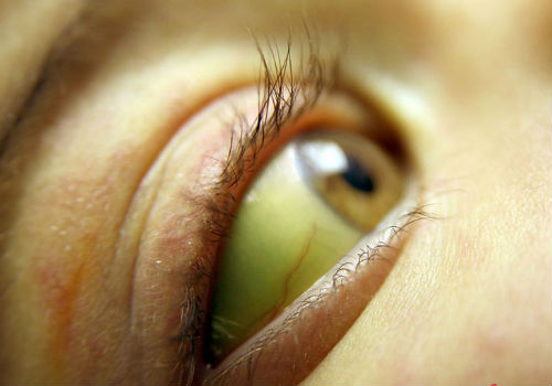 пожелтение глаз