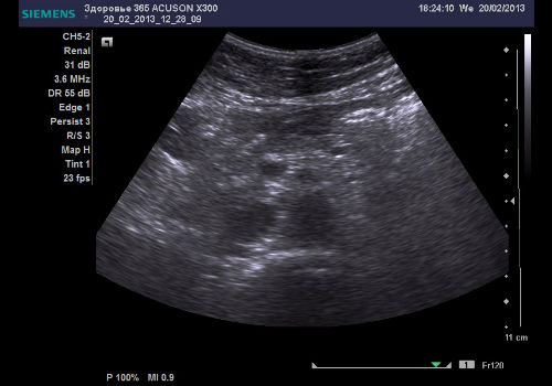 снимок УЗИ