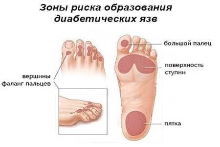 Схема появления язв на ногах Схема появления язв на ногах