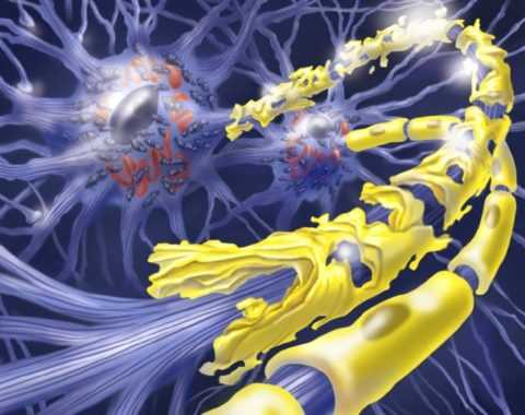 2 стадия нейропатии