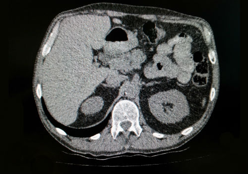 КТ брюшной полости