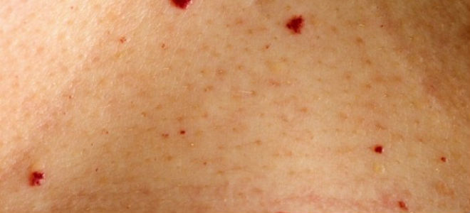 Красные точки Тужилина при панкреатите