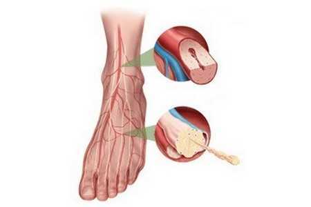 Нога с болезнью Нога с болезнью