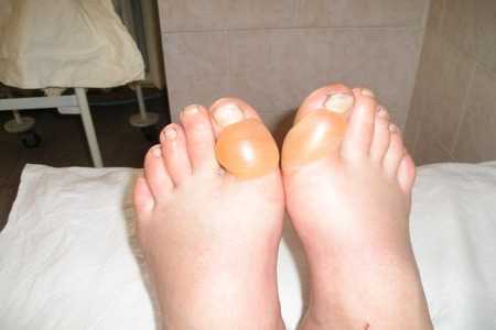 Ноги, диабетический пузырь