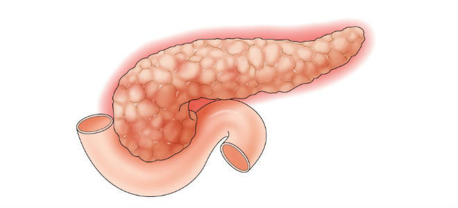 Хронический билиарнозависимый панкреатит