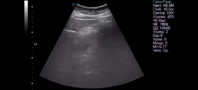 Причины и лечение острого отечного панкреатита: как и чем снять отёк поджелудочной железы?