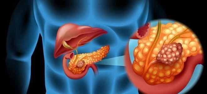 Проведение дренажа на поджелудочной железе: послеоперационная необходимость и результат