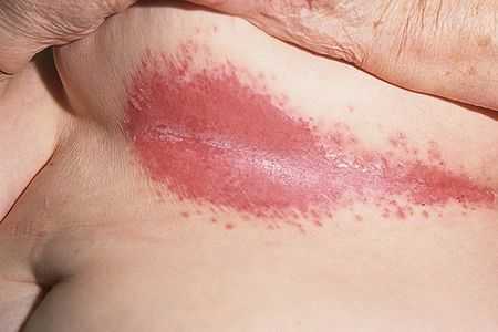сыпь на теле
