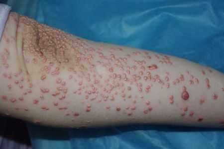 сыпь на руке