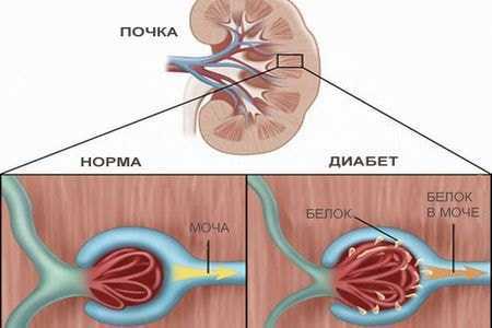 схема заболевания почек при сахарном диабете