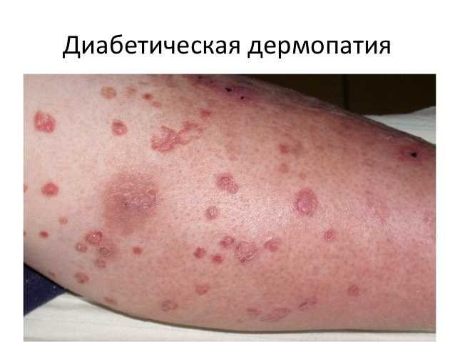 Нужно отказаться от употребления вредных напитков и сладостей.