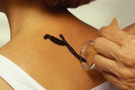 Пиявки на коже Пиявки на коже