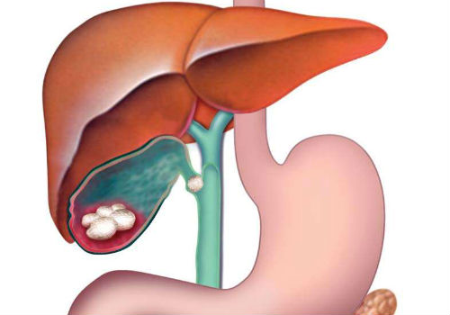 развитие дискинезии желчного пузыря