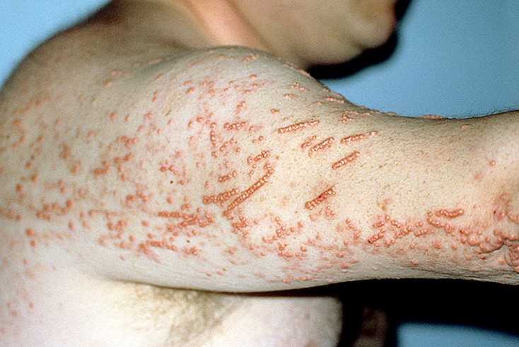 Бактериальные инфекции