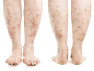 Что происходит с ногами при сахарном диабете