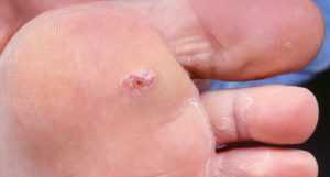 Трофические язвы на ногах при сахарном диабете