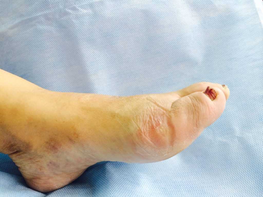 Диабетическая стопа