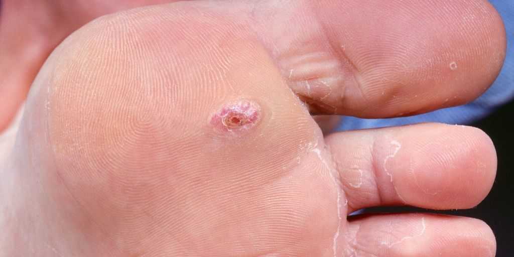 Что такое диабетическая стопа