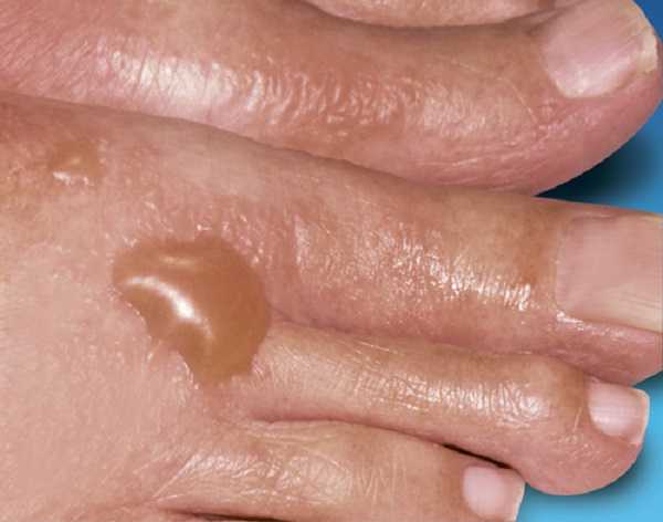 Диабетические волдыри