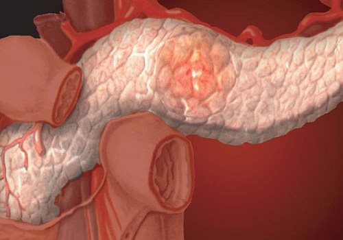 Диффузные изменения поджелудочной железы