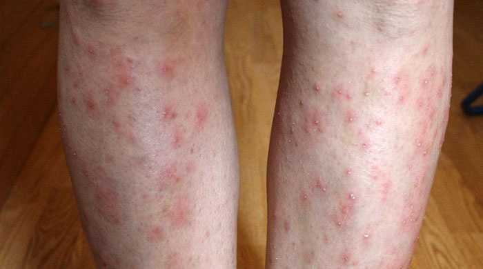 Другие кожные проявления и диабет