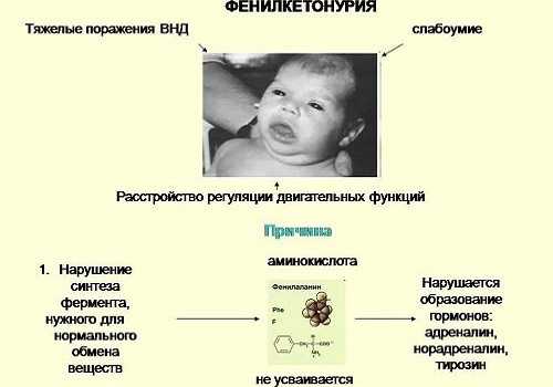 Фенилкетонурия