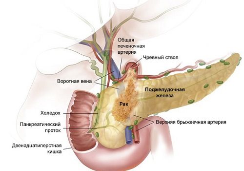 Фиброз поджелудочной железы