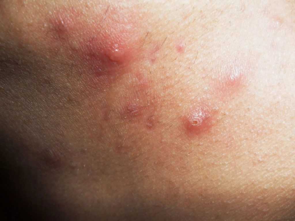 Фурункулез