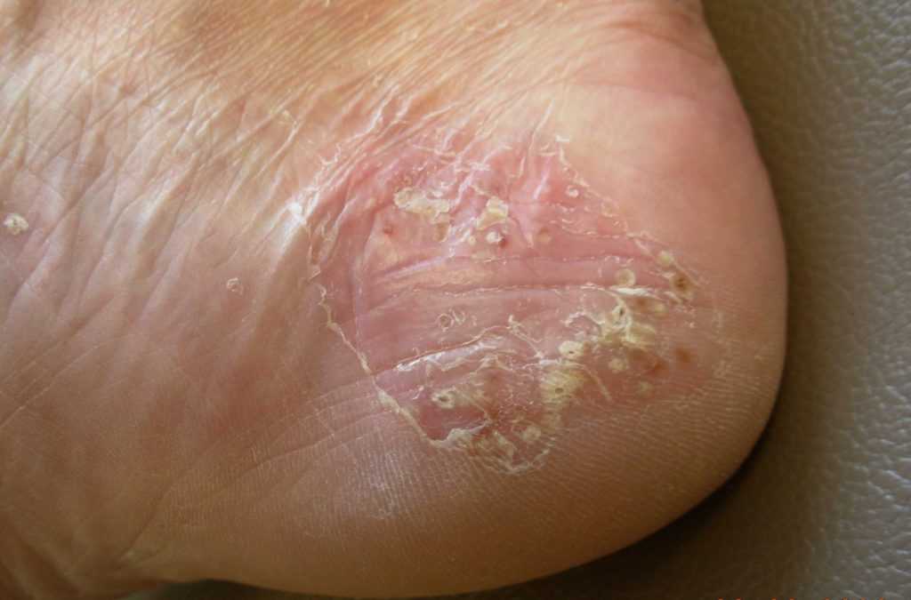 Гиперкератоз и трещины