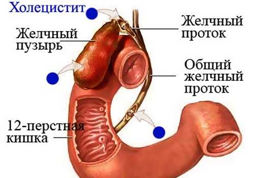 Холецистит